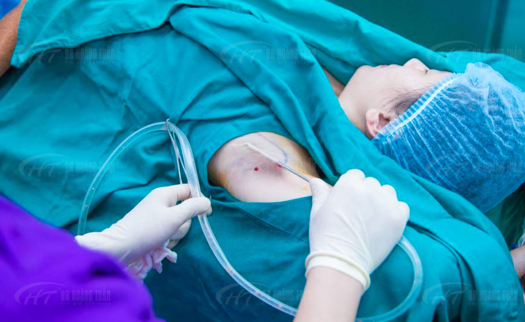 Phẫu thuật cắt tuyến mồ hôi nách có những hạn chế nhất định